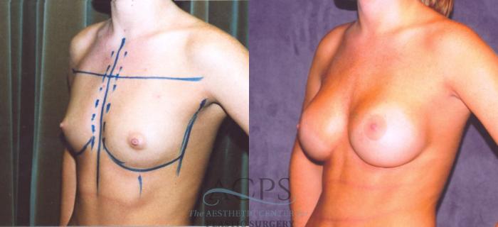 Before & After Breast Augmentation Case 862 Oblique View: View in Houston, TX