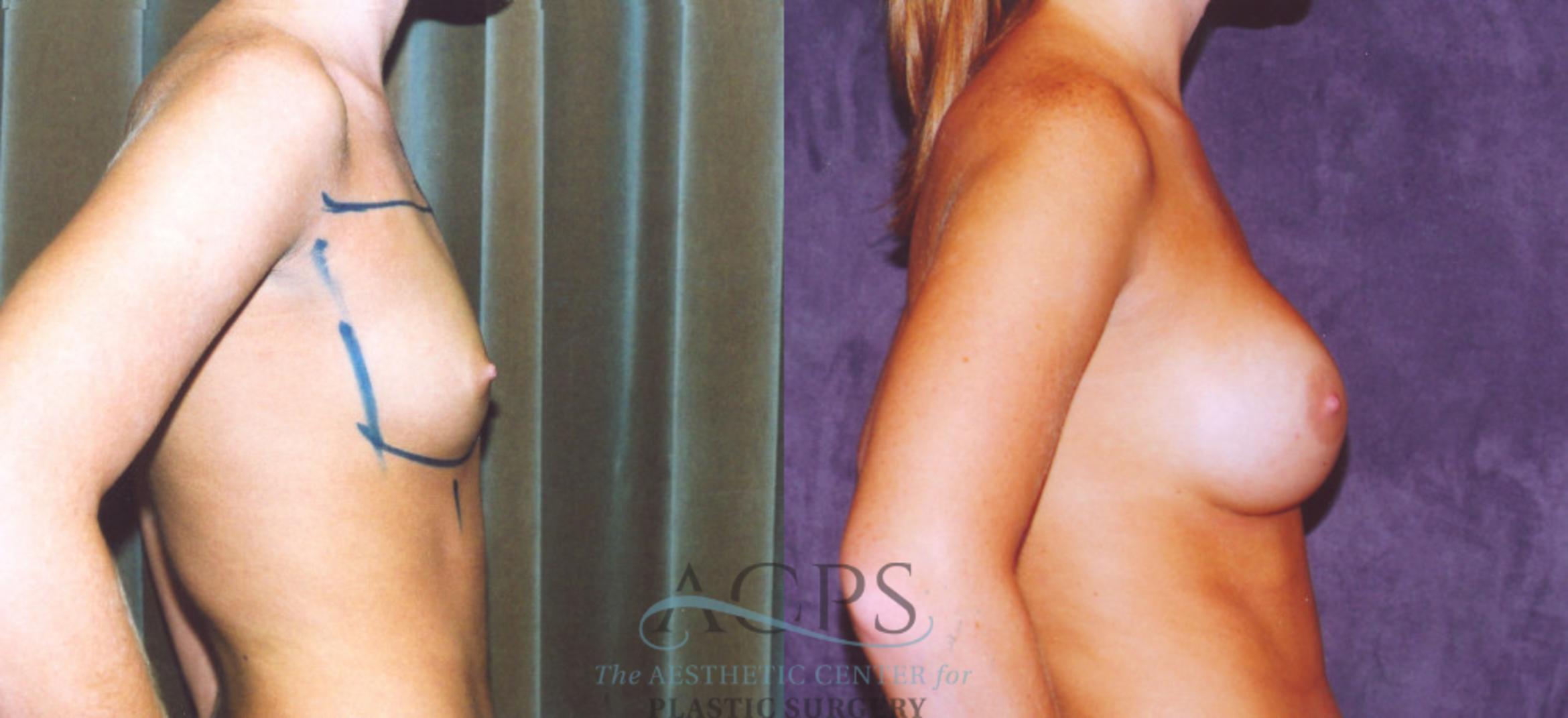 Before & After Breast Augmentation Case 862 Side View: View in Houston, TX
