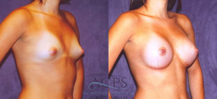 Before & After Breast Augmentation Case 863 Oblique View: View in Houston, TX
