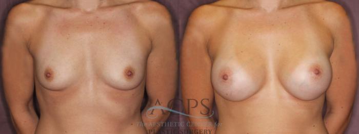 Before & After Breast Augmentation Case 874 Front View: View in Houston, TX
