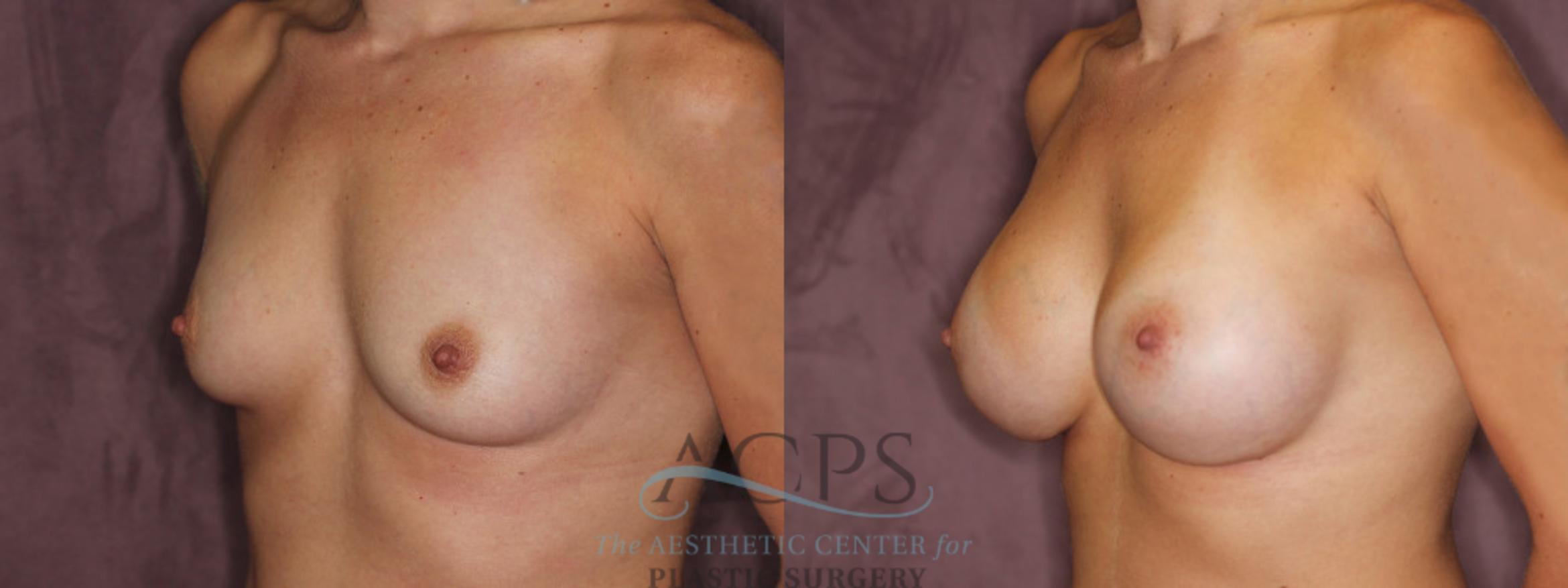 Before & After Breast Augmentation Case 874 Oblique Left View: View in Houston, TX