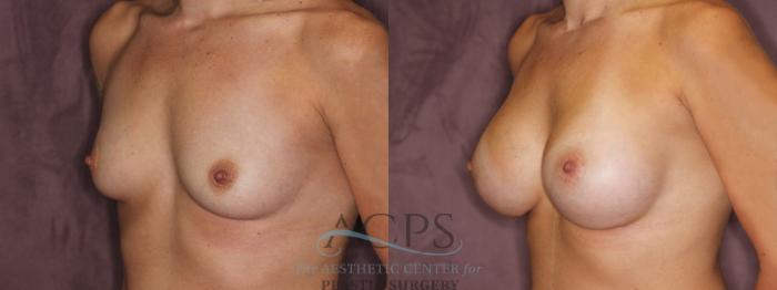 Before & After Breast Augmentation Case 874 Oblique Left View: View in Houston, TX