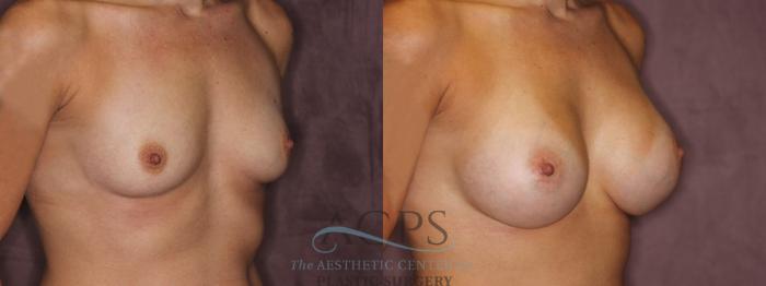 Before & After Breast Augmentation Case 874 Oblique Right View: View in Houston, TX