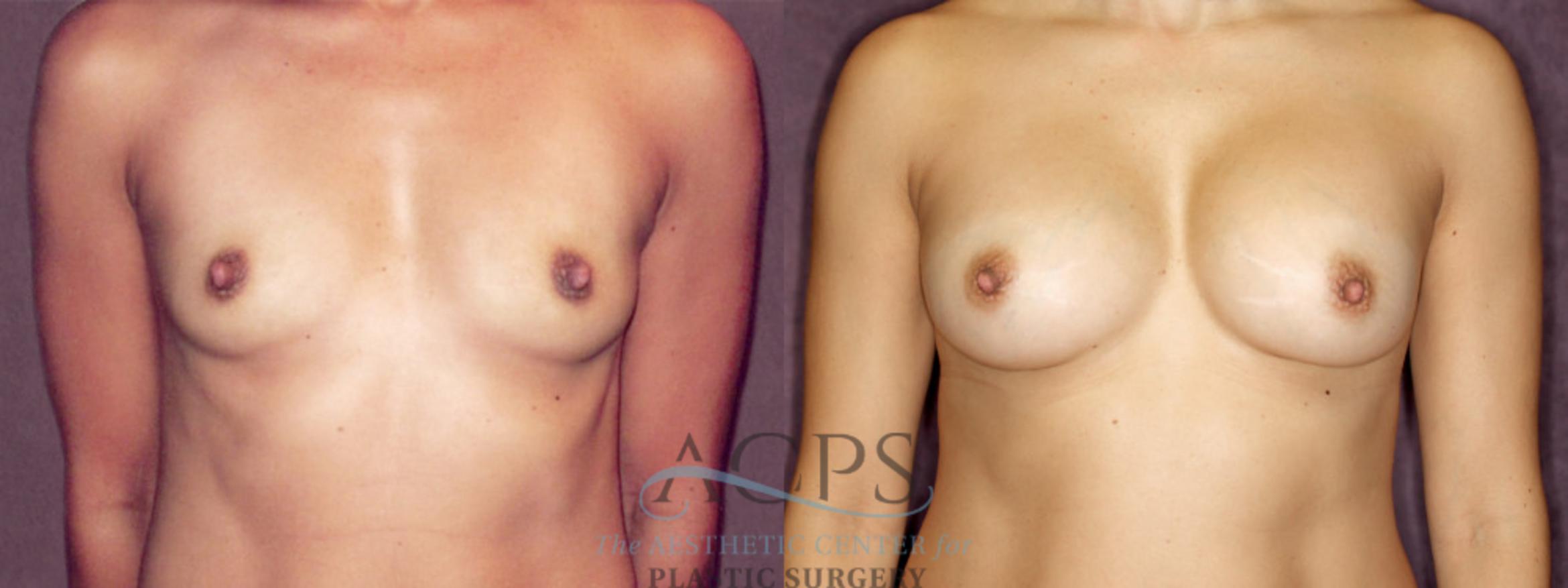 Before & After Breast Augmentation Case 875 Front View: View in Houston, TX