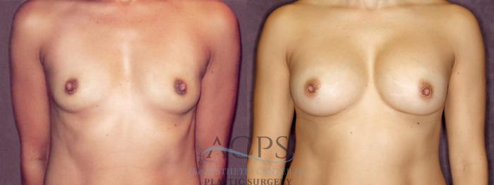 Before & After Breast Augmentation Case 875 Front View: View in Houston, TX