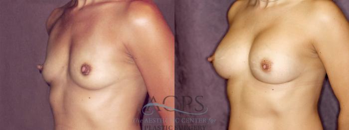 Before & After Breast Augmentation Case 875 Oblique Left View: View in Houston, TX