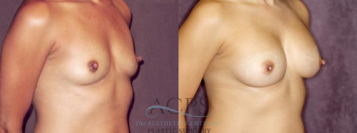 Before & After Breast Augmentation Case 875 Oblique Right View: View in Houston, TX