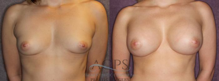 Before & After Breast Augmentation Case 876 Front View: View in Houston, TX