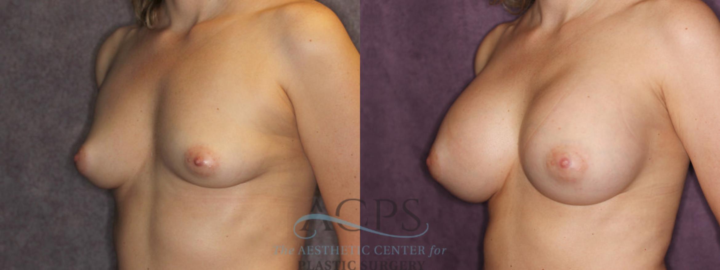 Before & After Breast Augmentation Case 876 Oblique Left View: View in Houston, TX