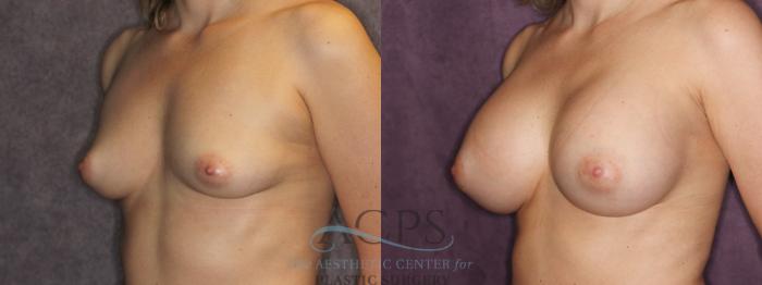 Before & After Breast Augmentation Case 876 Oblique Left View: View in Houston, TX