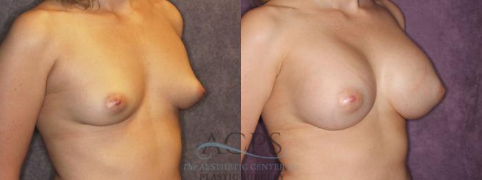Before & After Breast Augmentation Case 876 Oblique Right View: View in Houston, TX