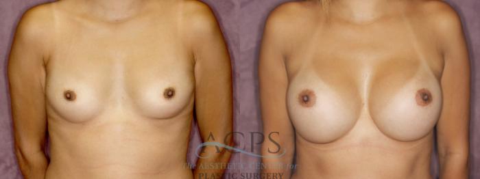 Before & After Breast Augmentation Case 877 Front View: View in Houston, TX