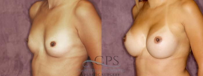 Before & After Breast Augmentation Case 877 Oblique Left View: View in Houston, TX