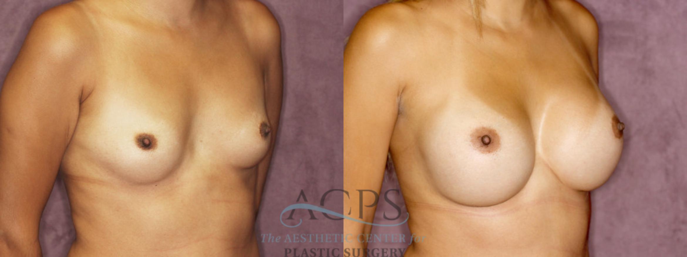 Before & After Breast Augmentation Case 877 Oblique Right View: View in Houston, TX