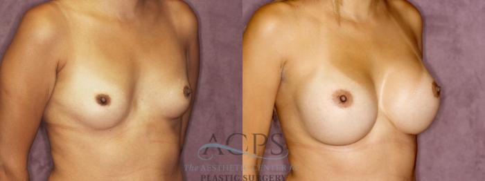 Before & After Breast Augmentation Case 877 Oblique Right View: View in Houston, TX