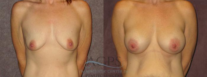 Before & After Breast Augmentation Case 878 Front View: View in Houston, TX