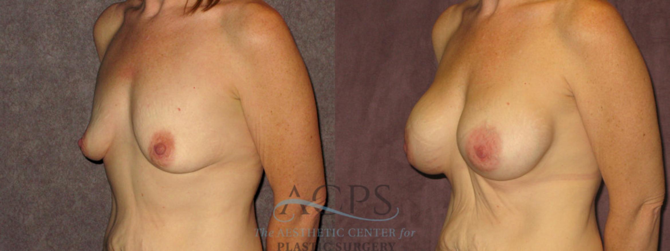 Before & After Breast Augmentation Case 878 Oblique Left View: View in Houston, TX