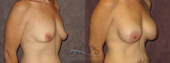 Before & After Breast Augmentation Case 878 Oblique Right View: View in Houston, TX