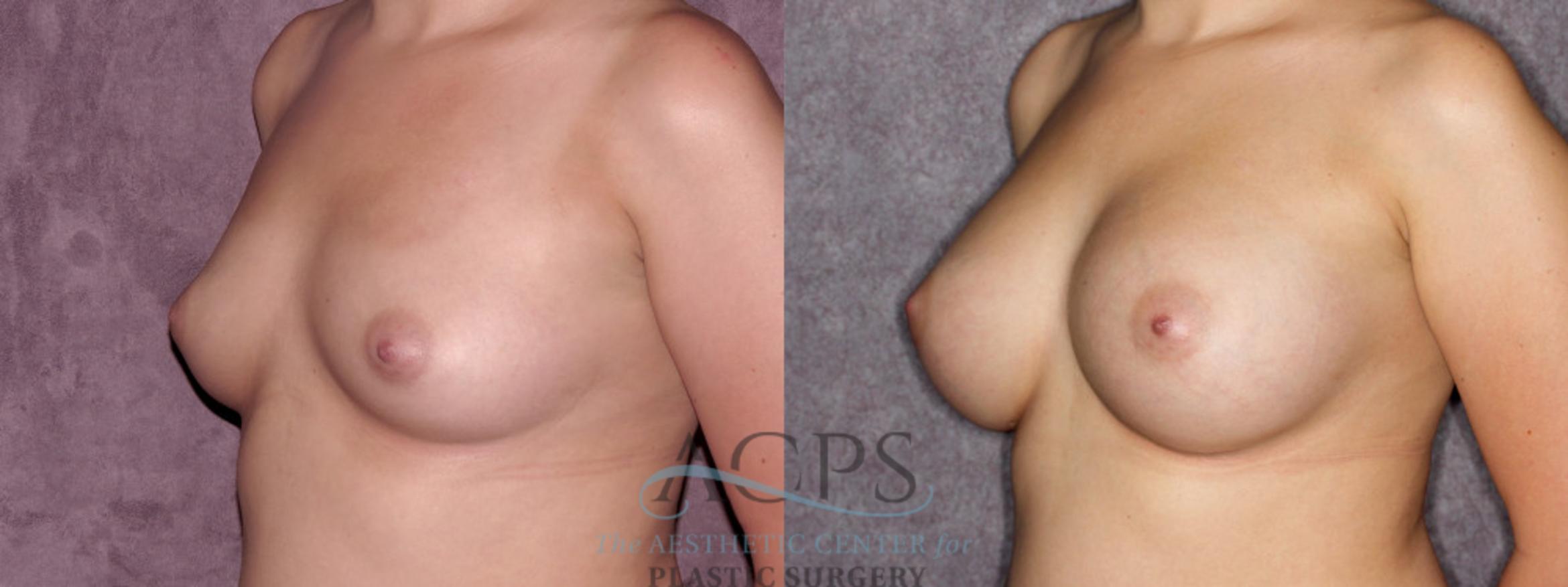 Before & After Breast Augmentation Case 880 Oblique Left View: View in Houston, TX