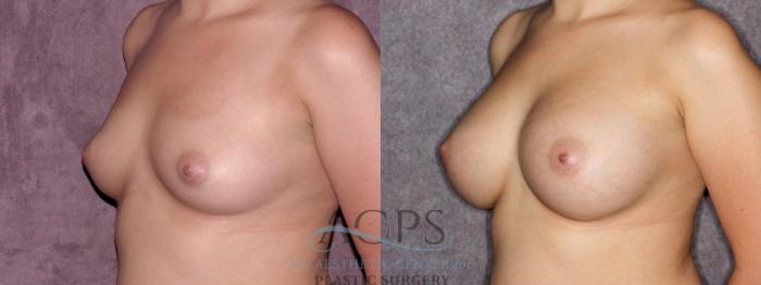 Before & After Breast Augmentation Case 880 Oblique Left View: View in Houston, TX