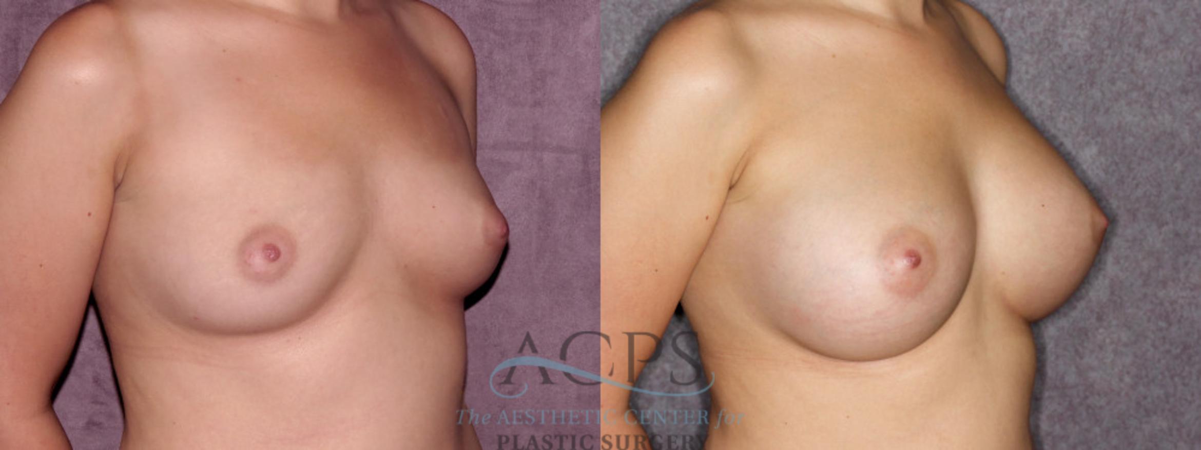 Before & After Breast Augmentation Case 880 Oblique Right View: View in Houston, TX