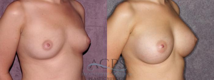 Before & After Breast Augmentation Case 880 Oblique Right View: View in Houston, TX