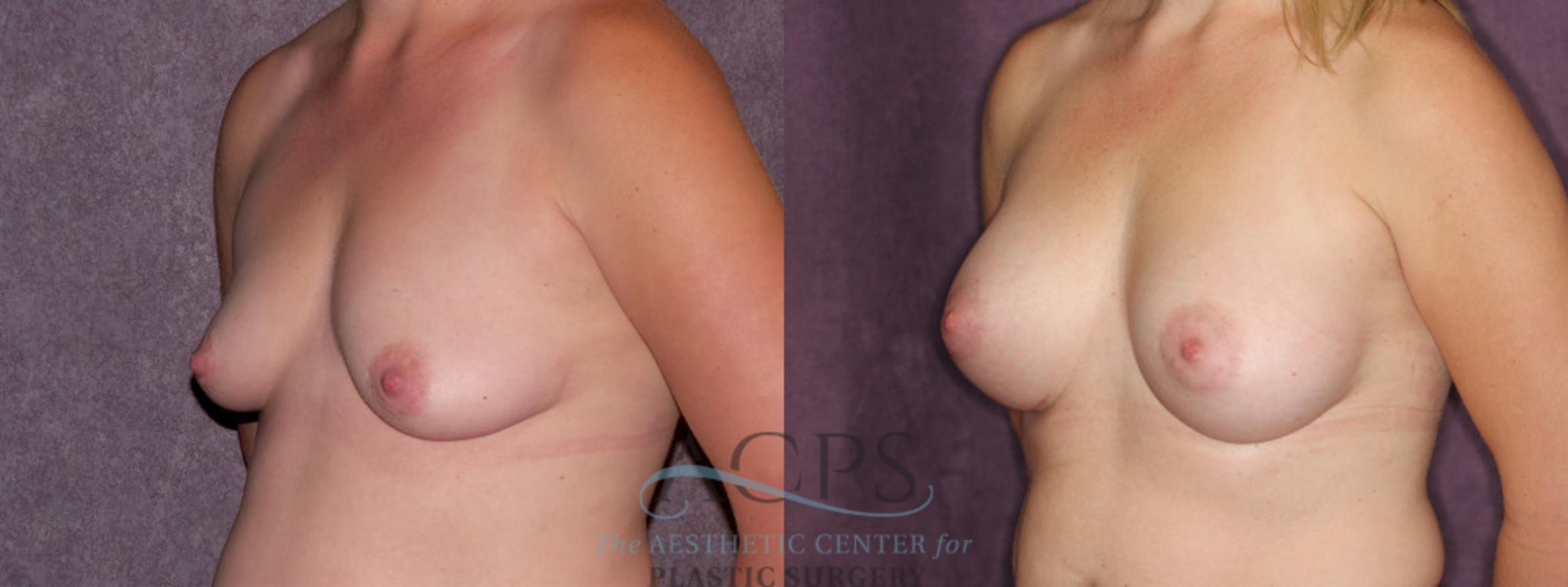 Before & After Breast Augmentation Case 881 Oblique Left View: View in Houston, TX