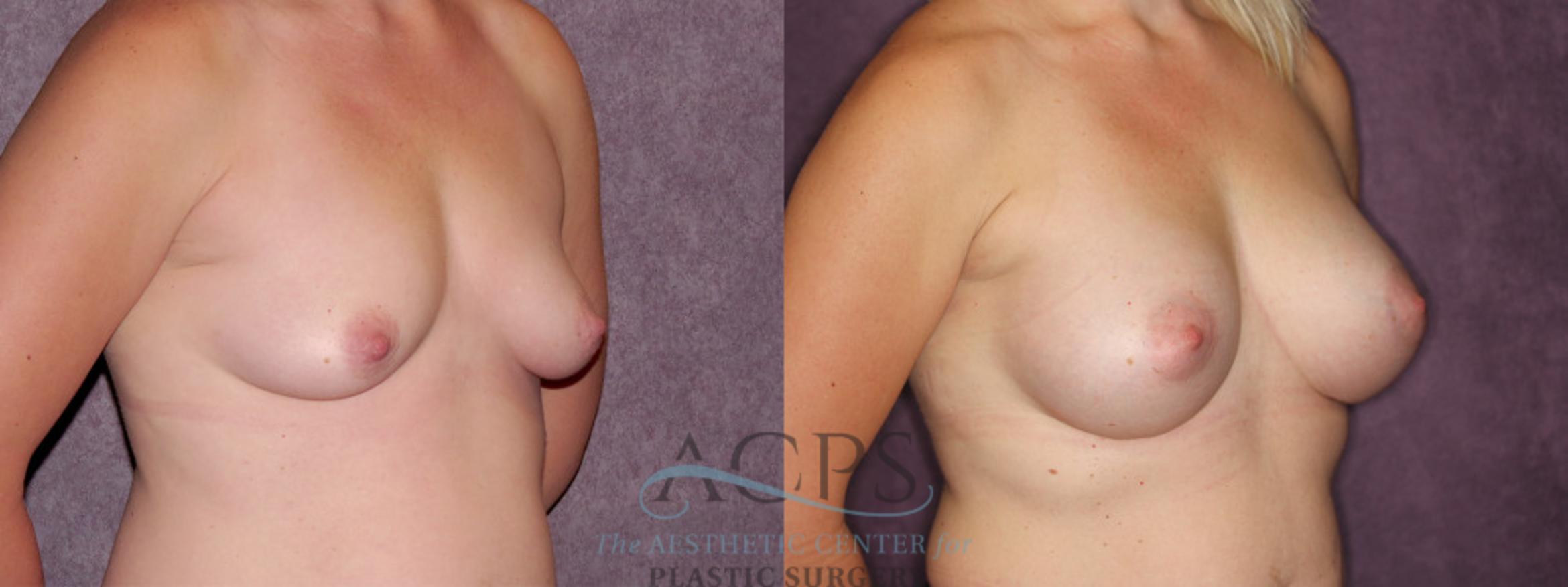 Before & After Breast Augmentation Case 881 Oblique Right View: View in Houston, TX