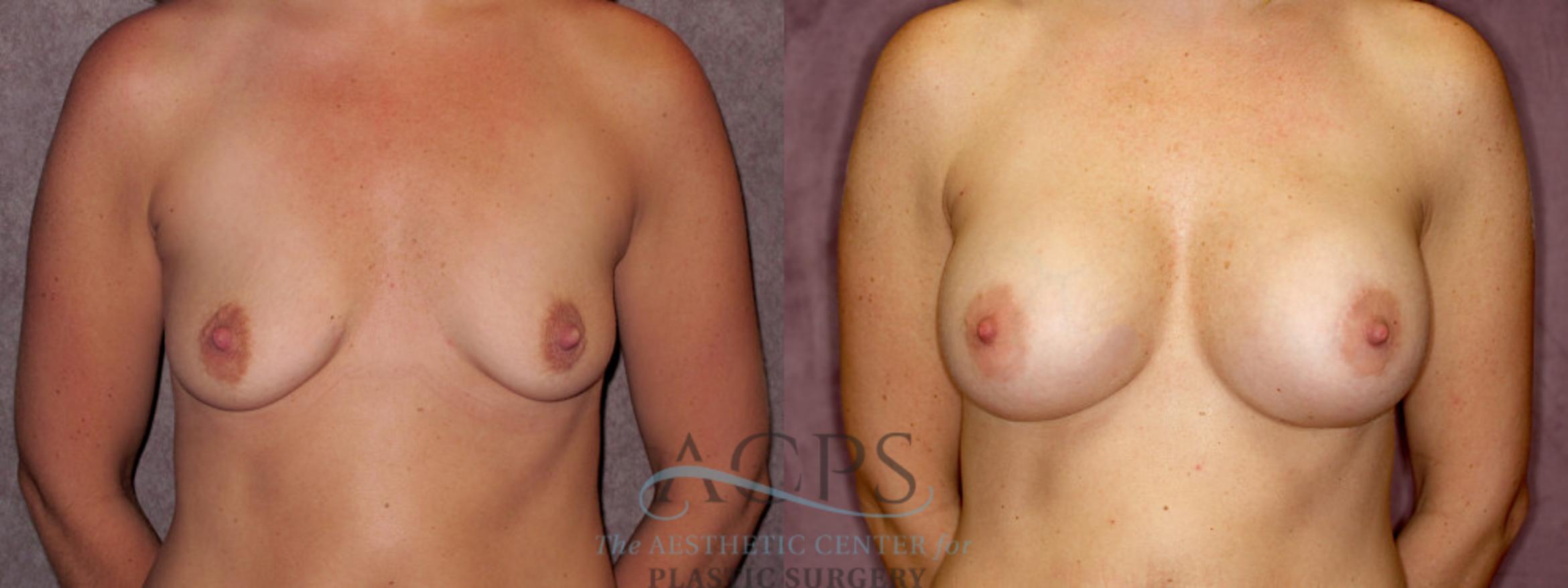 Before & After Breast Augmentation Case 882 Front View: View in Houston, TX