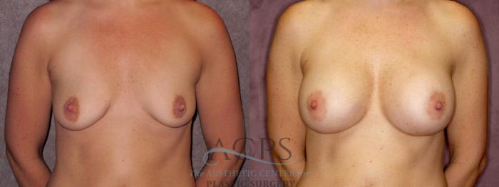 Before & After Breast Augmentation Case 882 Front View: View in Houston, TX