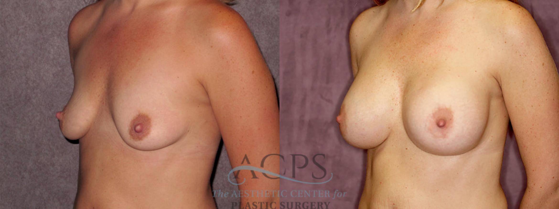 Before & After Breast Augmentation Case 882 Oblique Left View: View in Houston, TX