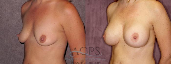 Before & After Breast Augmentation Case 882 Oblique Left View: View in Houston, TX