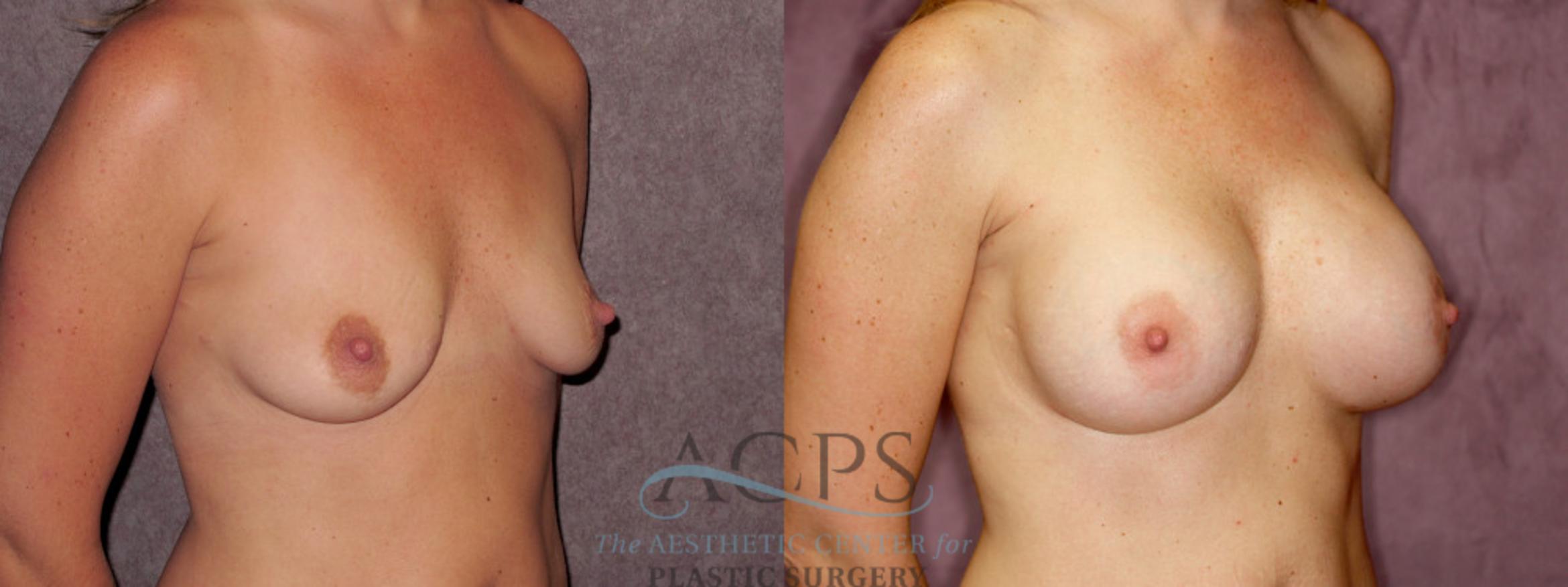 Before & After Breast Augmentation Case 882 Oblique Right View: View in Houston, TX