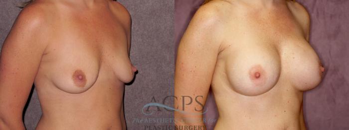Before & After Breast Augmentation Case 882 Oblique Right View: View in Houston, TX