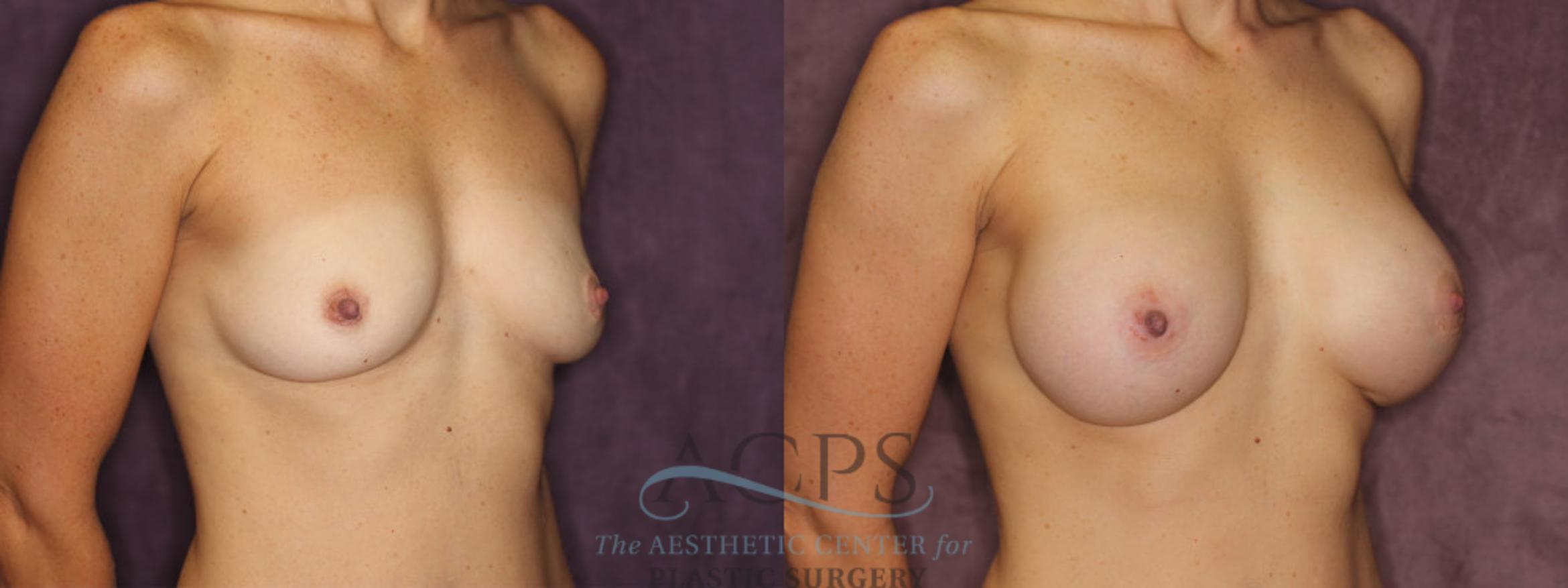 Before & After Breast Augmentation Case 883 Oblique Right View: View in Houston, TX