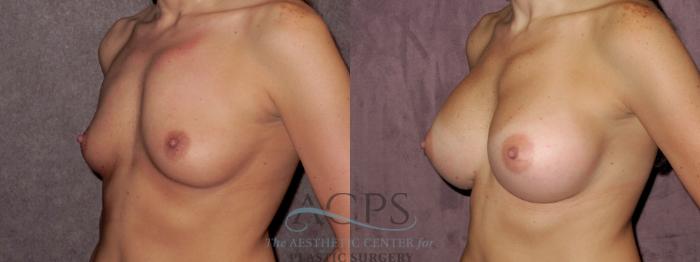 Before & After Breast Augmentation Case 884 Oblique Left View: View in Houston, TX