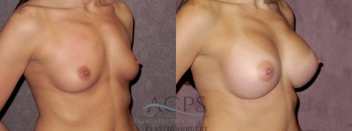 Before & After Breast Augmentation Case 884 Oblique Right View: View in Houston, TX