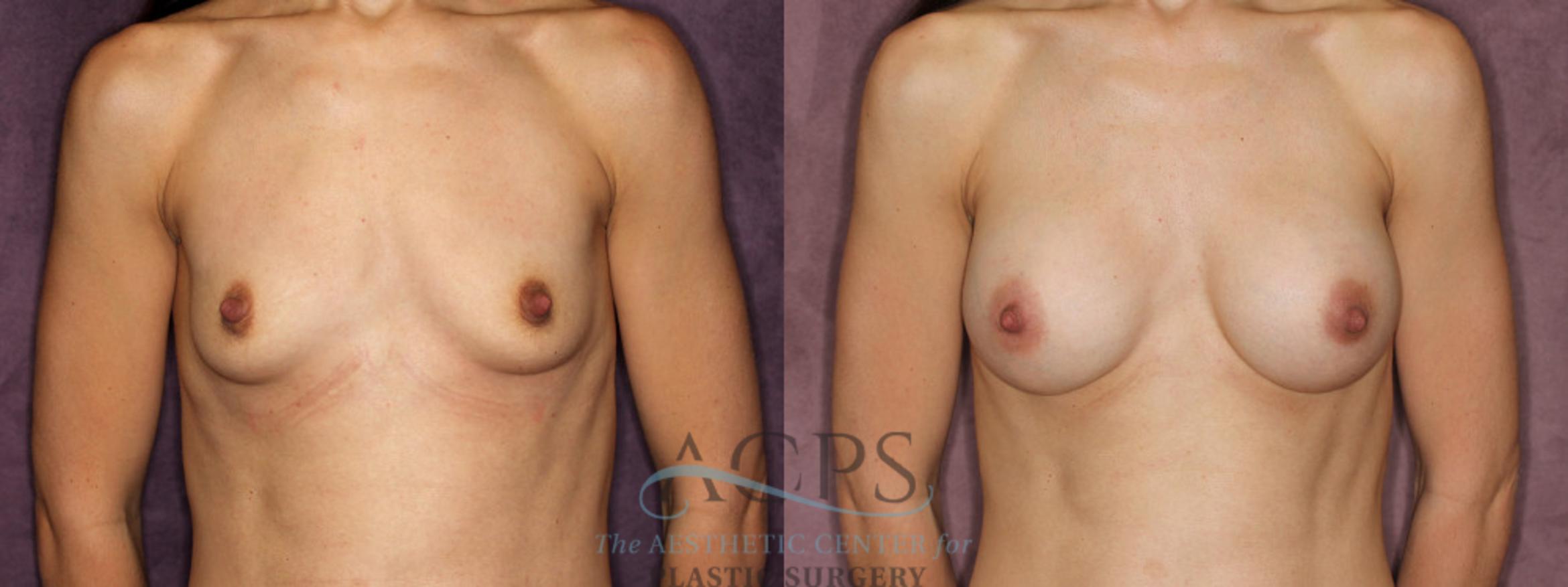 Before & After Breast Augmentation Case 885 Front View: View in Houston, TX