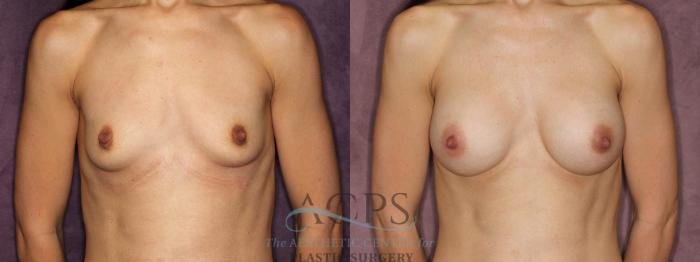 Before & After Breast Augmentation Case 885 Front View: View in Houston, TX