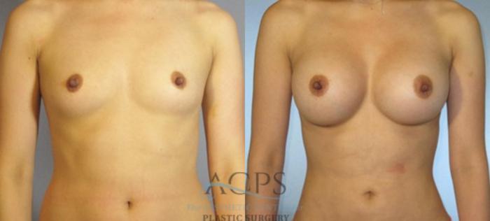 Before & After Breast Augmentation Case 886 Front View: View in Houston, TX