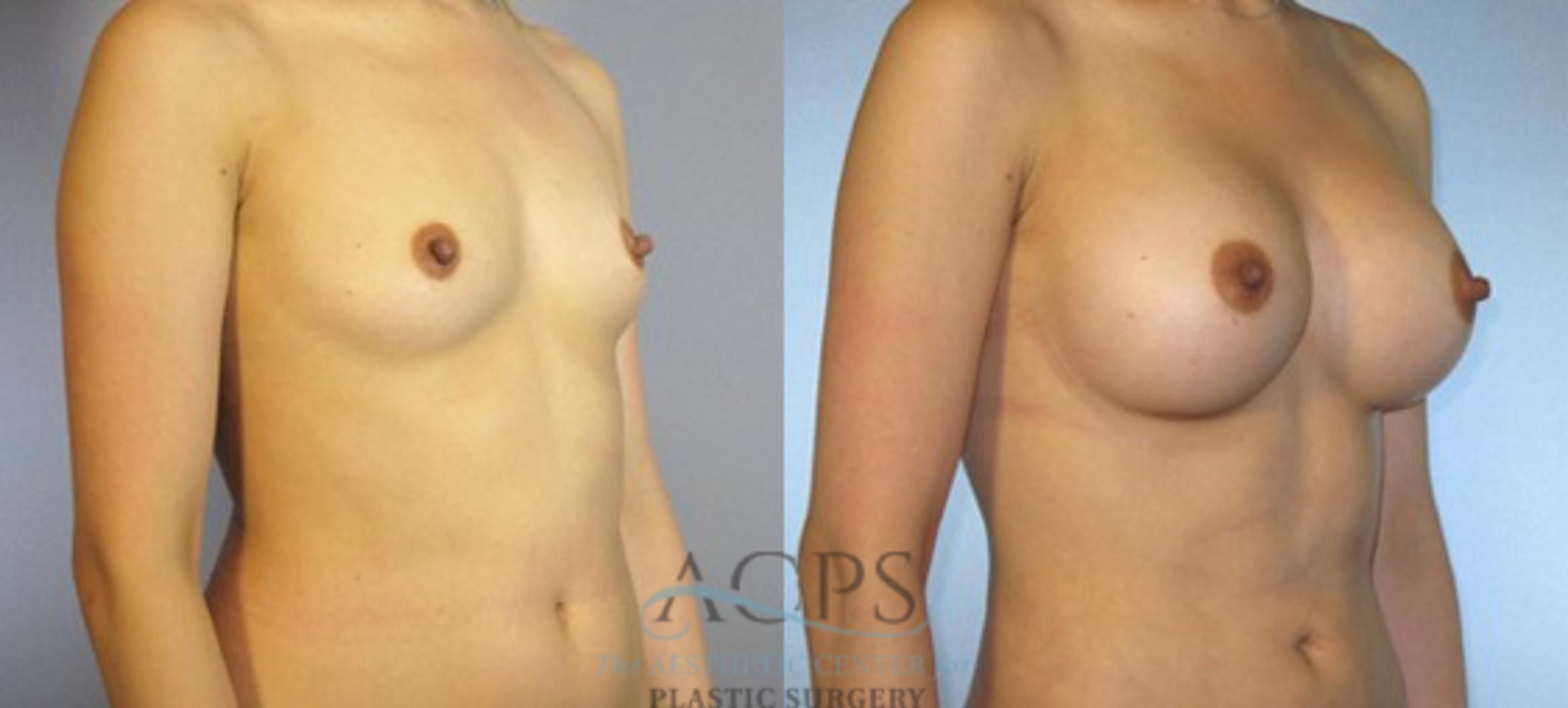 Before & After Breast Augmentation Case 886 Oblique View: View in Houston, TX