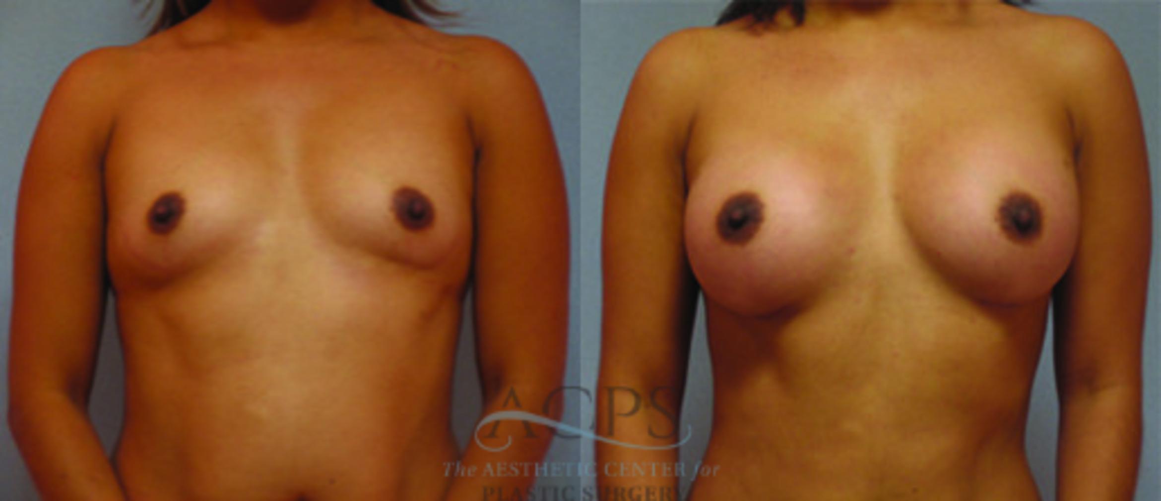 Before & After Breast Augmentation Case 887 Front View: View in Houston, TX