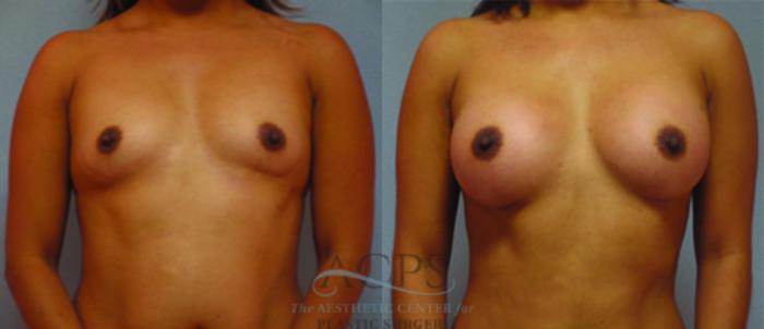 Before & After Breast Augmentation Case 887 Front View: View in Houston, TX