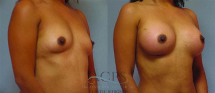 Before & After Breast Augmentation Case 887 Oblique View: View in Houston, TX