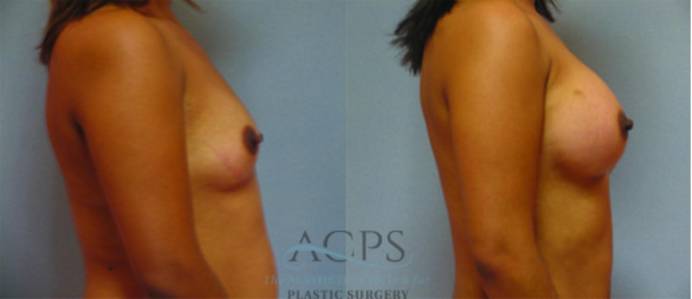 Before & After Breast Augmentation Case 887 Side View: View in Houston, TX