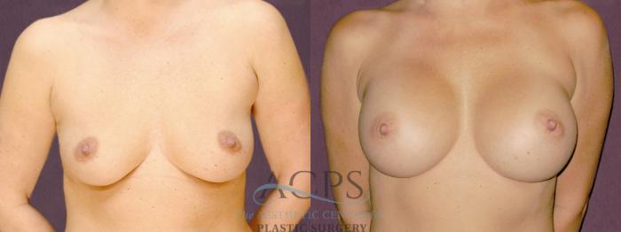Before & After Breast Augmentation Case 889 Front View: View in Houston, TX