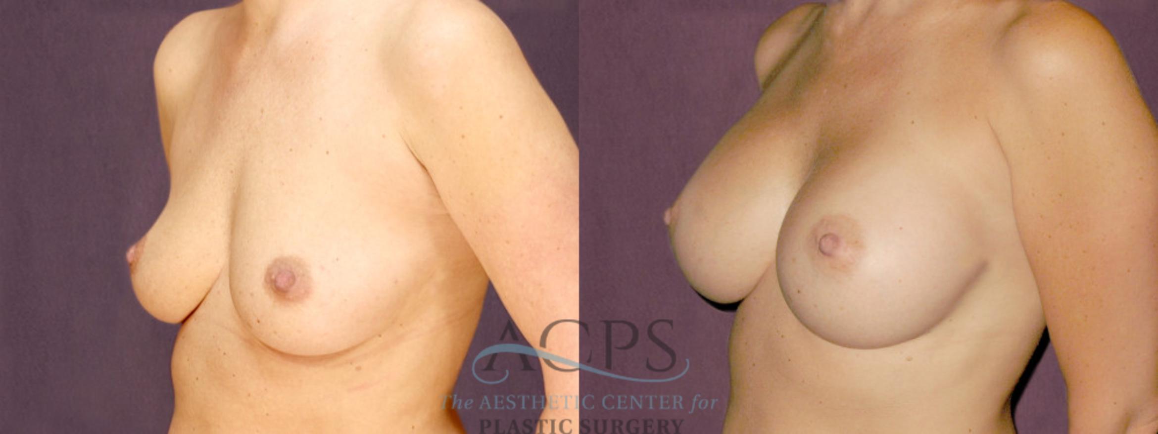 Before & After Breast Augmentation Case 889 Oblique Left View: View in Houston, TX