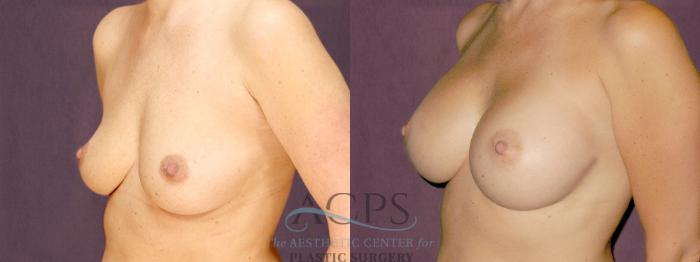 Before & After Breast Augmentation Case 889 Oblique Left View: View in Houston, TX