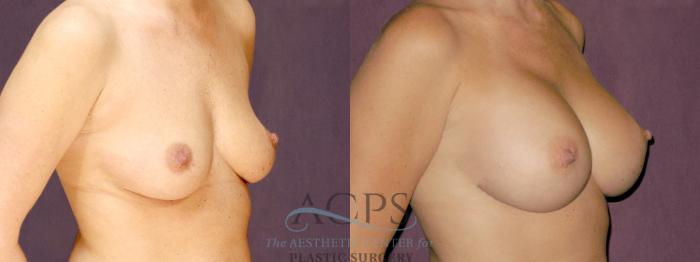 Before & After Breast Augmentation Case 889 Oblique Right View: View in Houston, TX