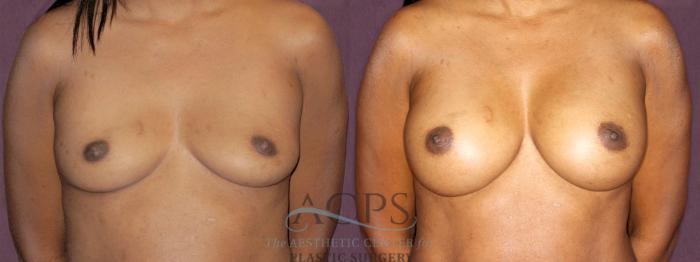 Before & After Breast Augmentation Case 890 Front View: View in Houston, TX